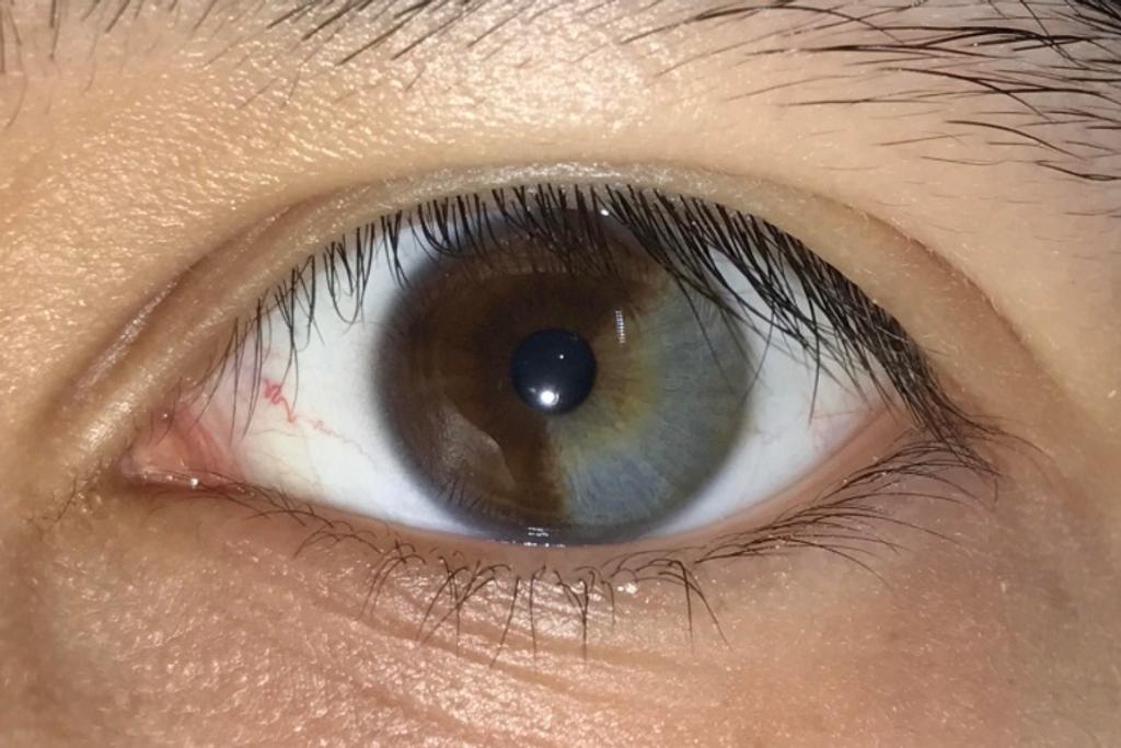 Partial Heterochromia Unique Traits 