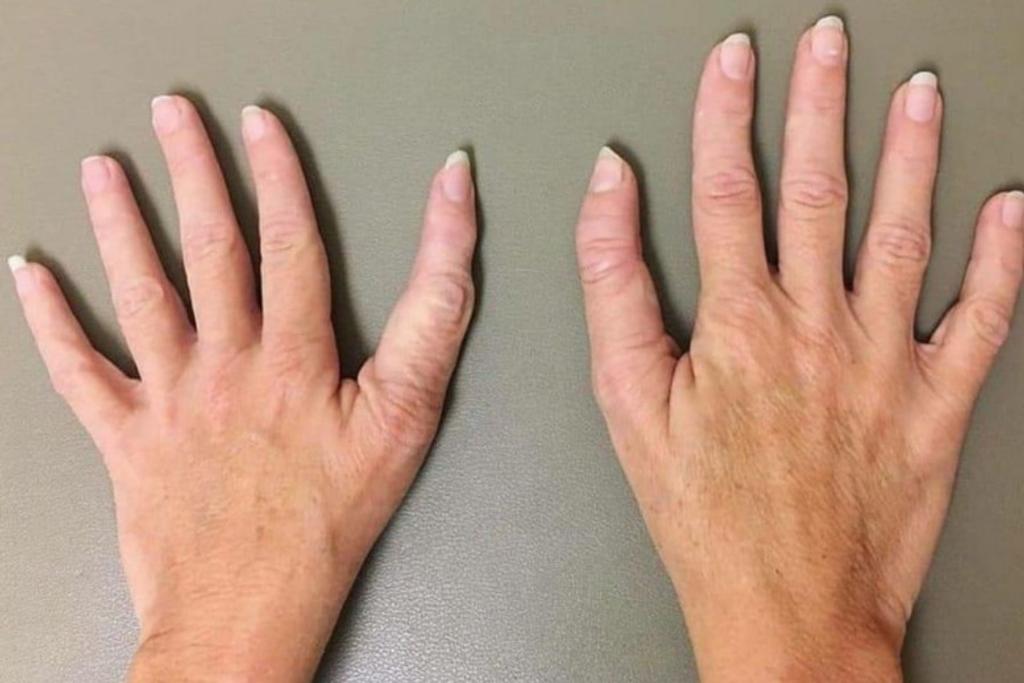 Unique Hands Triphalangeal Thumb 