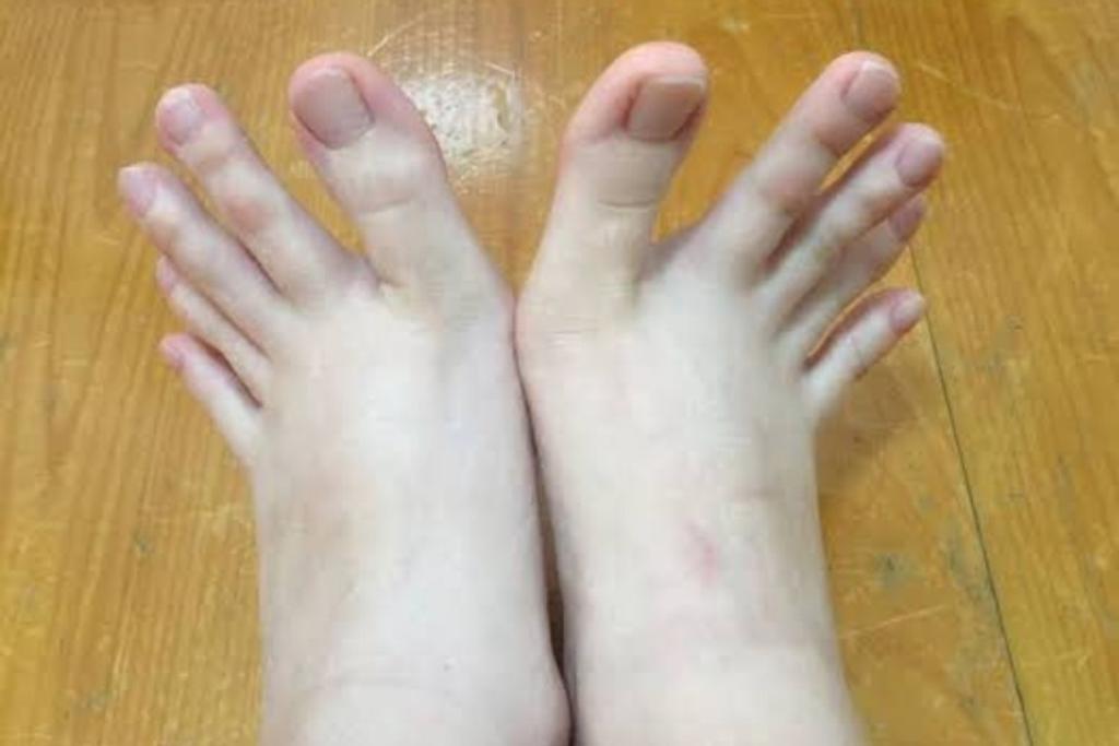 Unique Human Feet Arachnodactyly