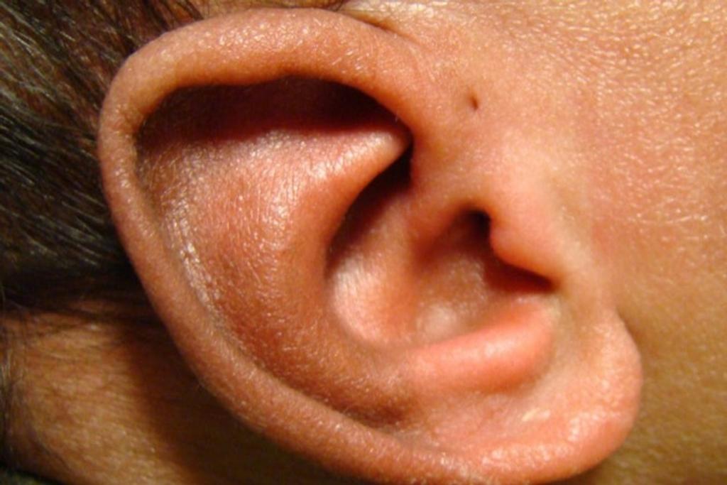 Preauricular Pits Ear Trait
