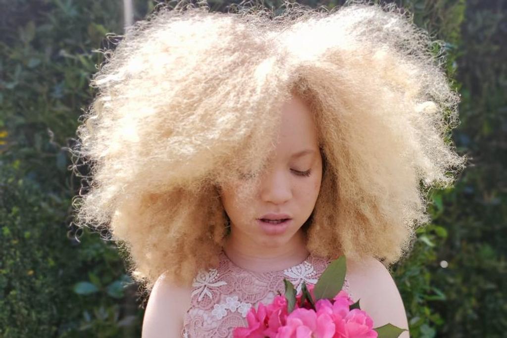 Ava clarke, albinism, condition