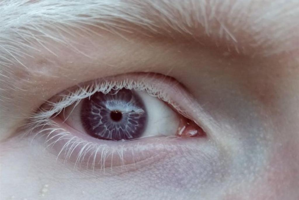 Purple eyes, albino, unique