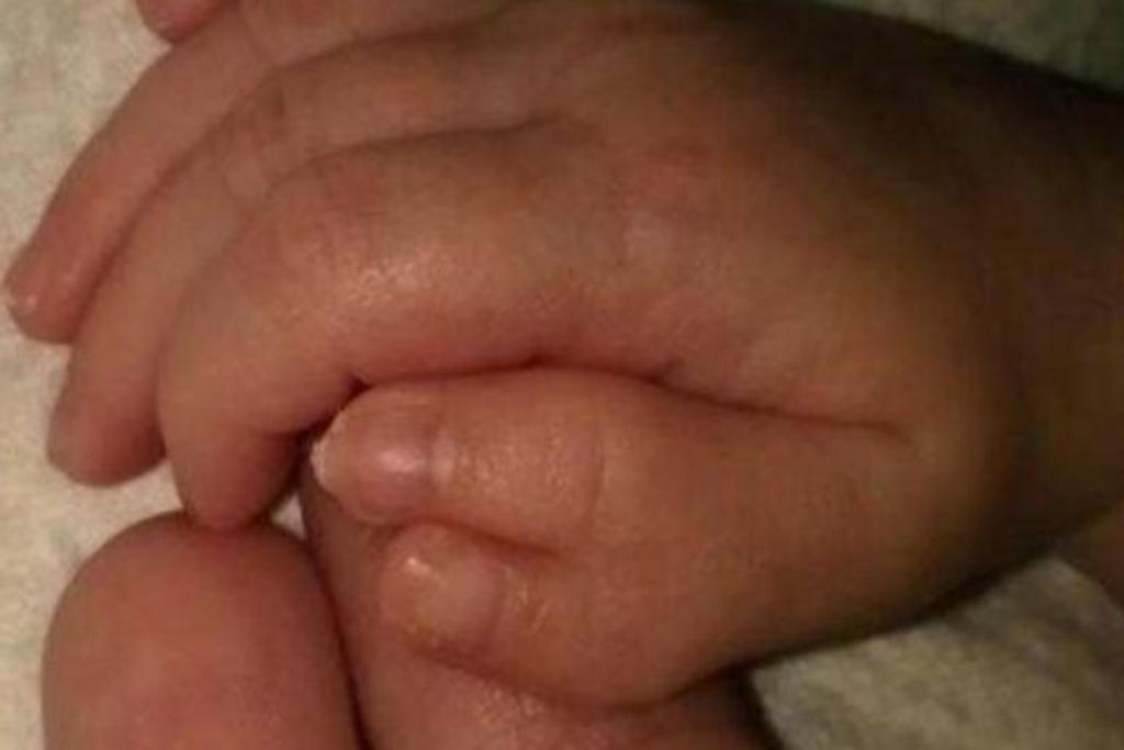 polydactyly, thumb, reddit, condition