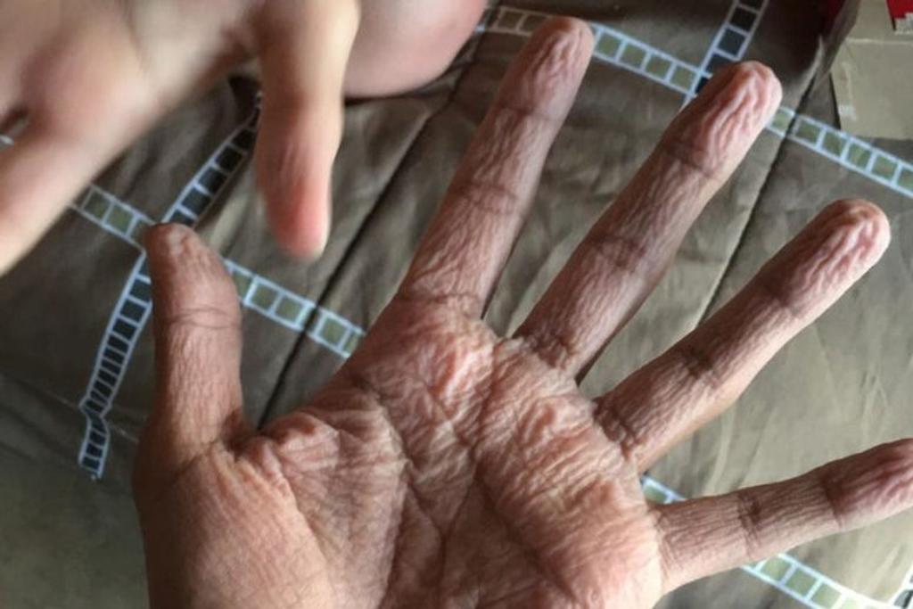 Pruney hands, condition, unique