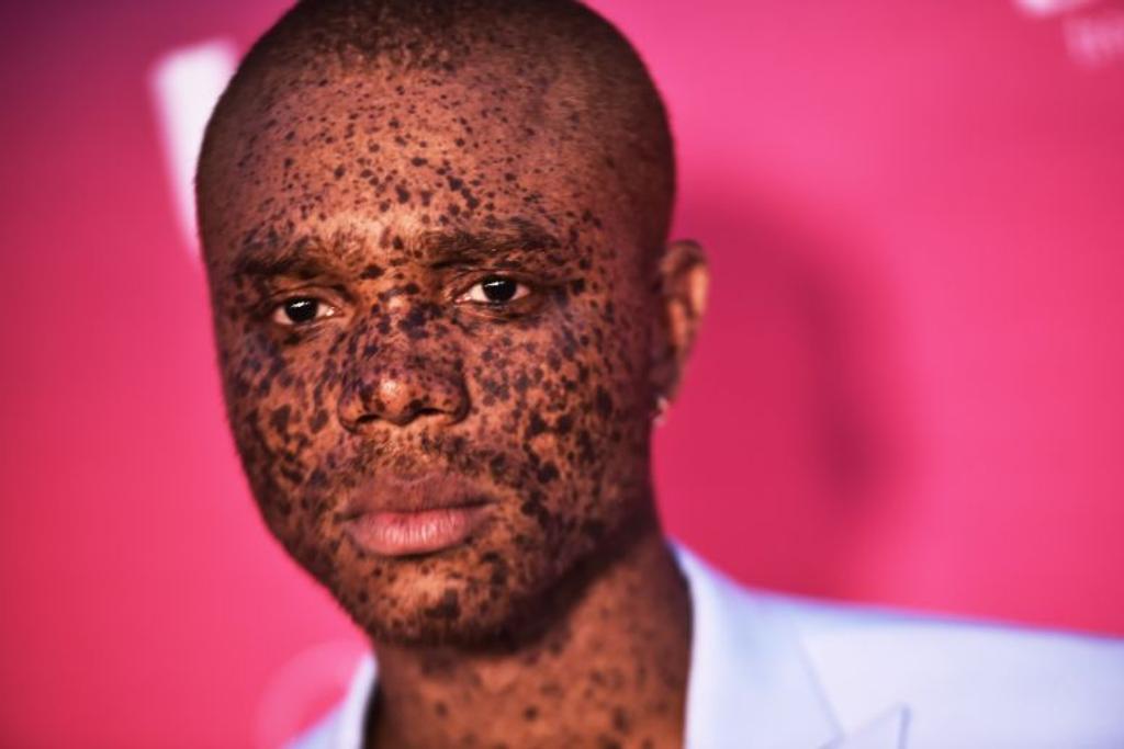 Souffrant Ralph, freckles, vitiligo