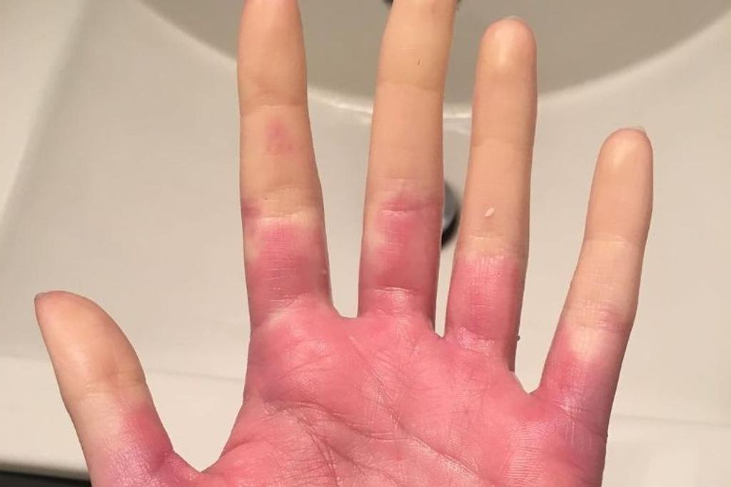 Raynaud's syndrome, unique, condition