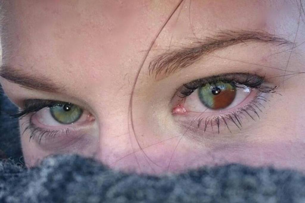 heterochromia rare genetic conditions