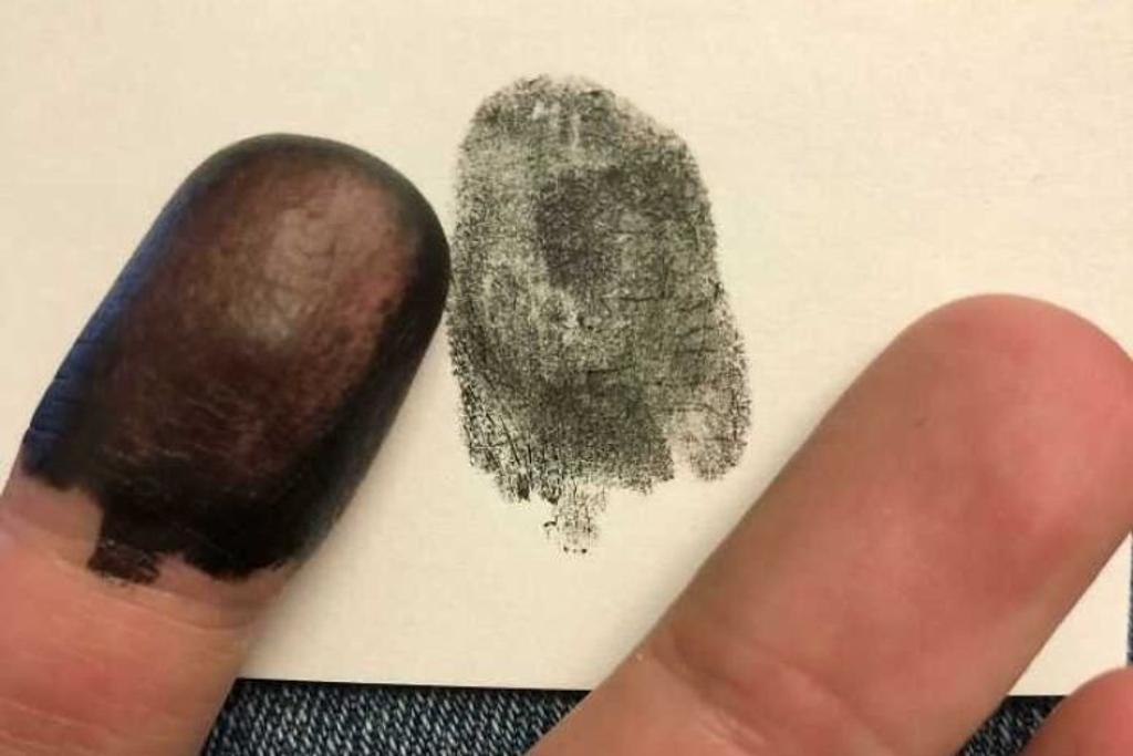 adermatoglyphia fingerprints rare condition