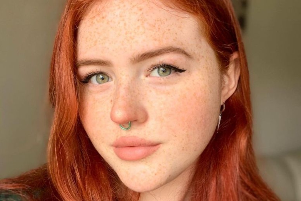 freckles rare genetic mutation