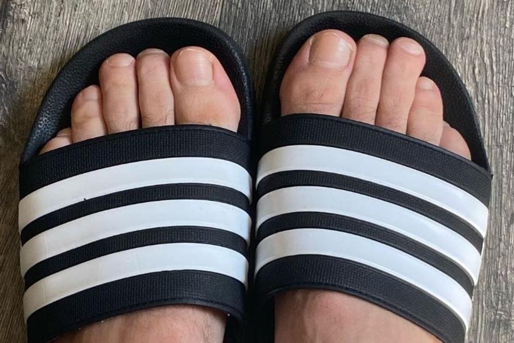 morton's toe rare condition