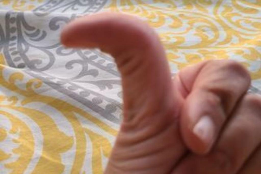 hitchhiker's thumb rare condition