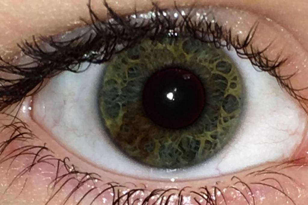 green eyes heterochromia rare