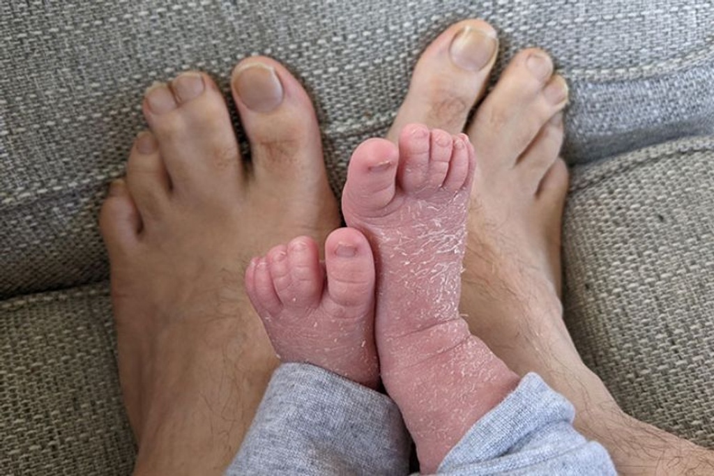webbed feet rare genetic
