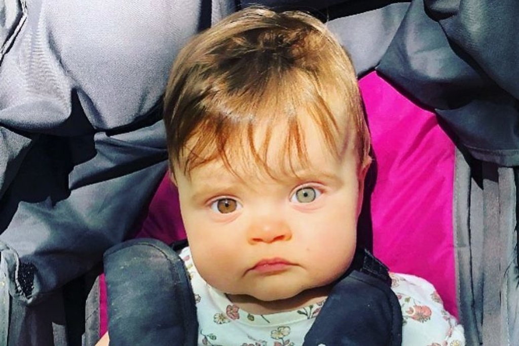 Heterochromia baby rare condition