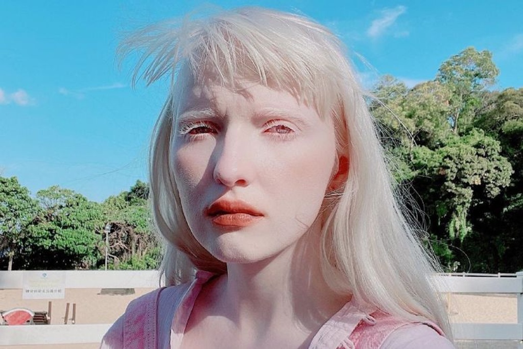 Albinism model rare instagram