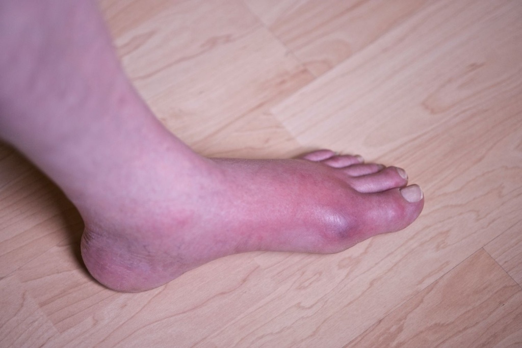 covid symptoms toes chilblains