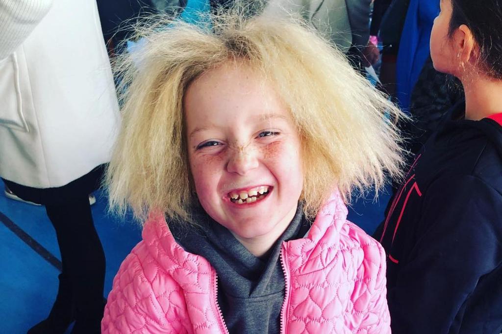 Uncombable Hair Syndrome genetic